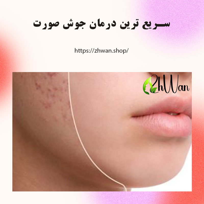سریع ترین درمان جوش صورت