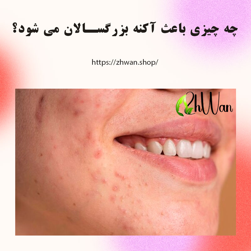 چه چیزی باعث آکنه بزرگسالان می شود؟